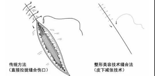 尽量到正规医院的美容整形科或皮肤科采取减张美容缝合,待拆线后再