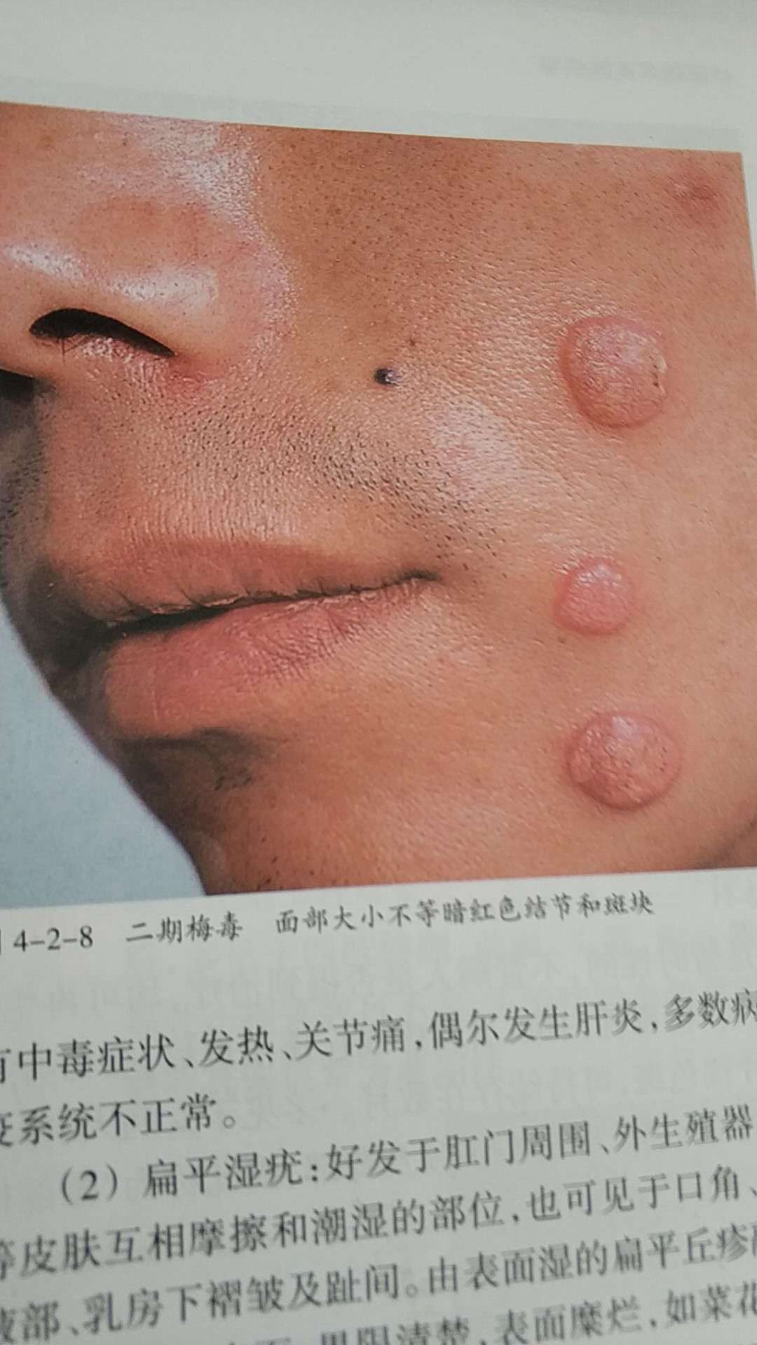 二期梅毒疹