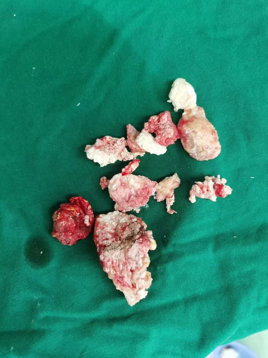 患者:医生,昨晚我的脚痛疯了! 医生:你的确是痛风了!
