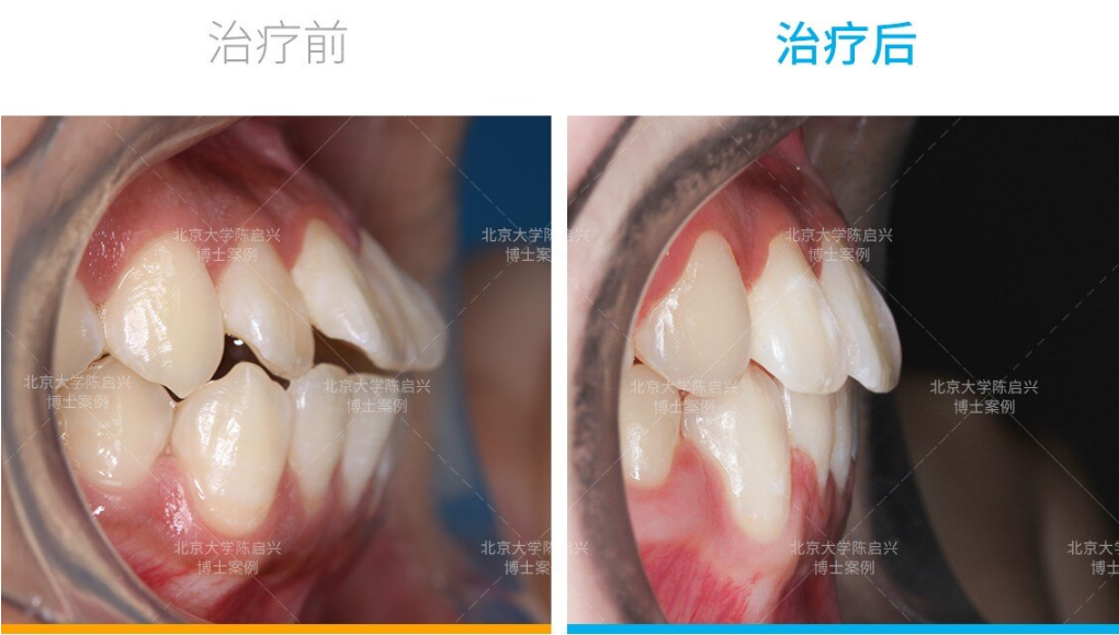 双颌前突,改善嘴突的矫正案例_牙颌畸形 - 好大夫在线