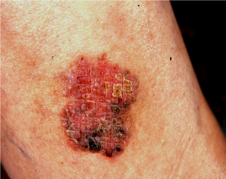 皮肤上持续不消退的小斑块需要警惕鲍温病一种早期鳞状细胞癌