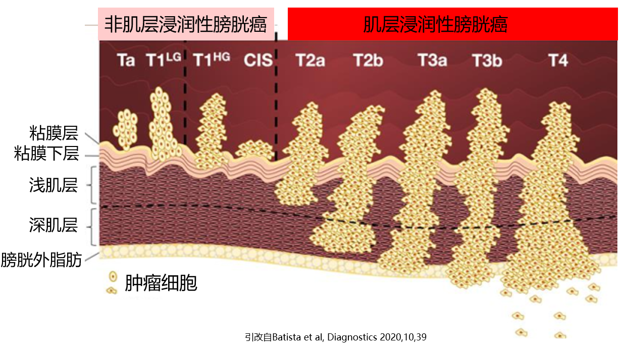 肿瘤 发现的相对早,癌细胞只是局限在粘膜层和粘膜下层,则称为非肌层