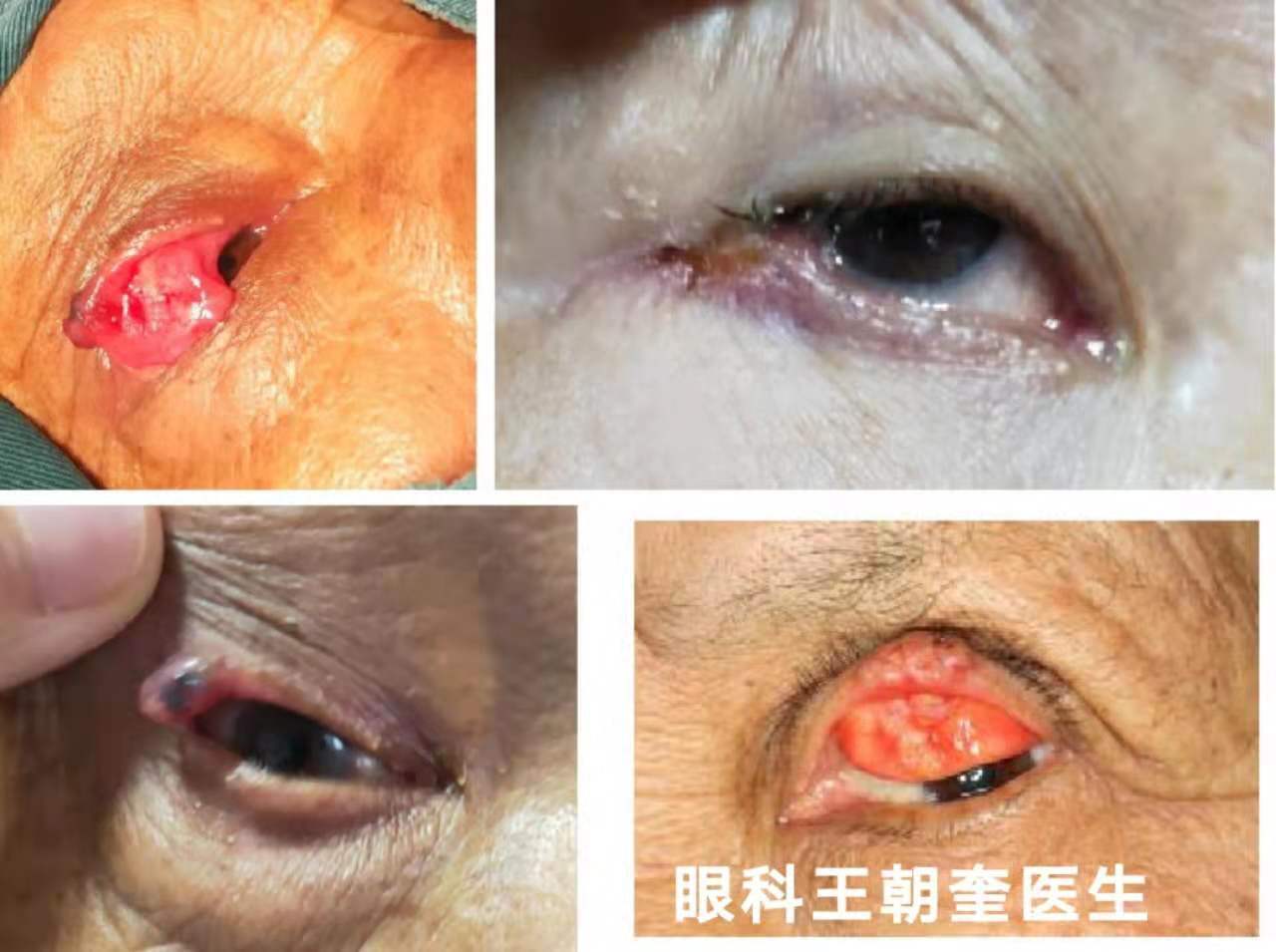 3.眼睑鳞状细胞癌多见于老年人,男性居多,好发于睑缘皮肤黏膜移行处.
