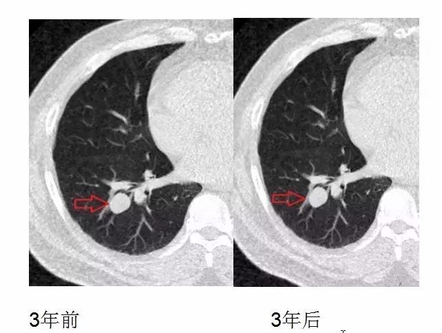 钙化的结节不需要切的肺结节发现肺部结节以后,哪些需要及时手术切除