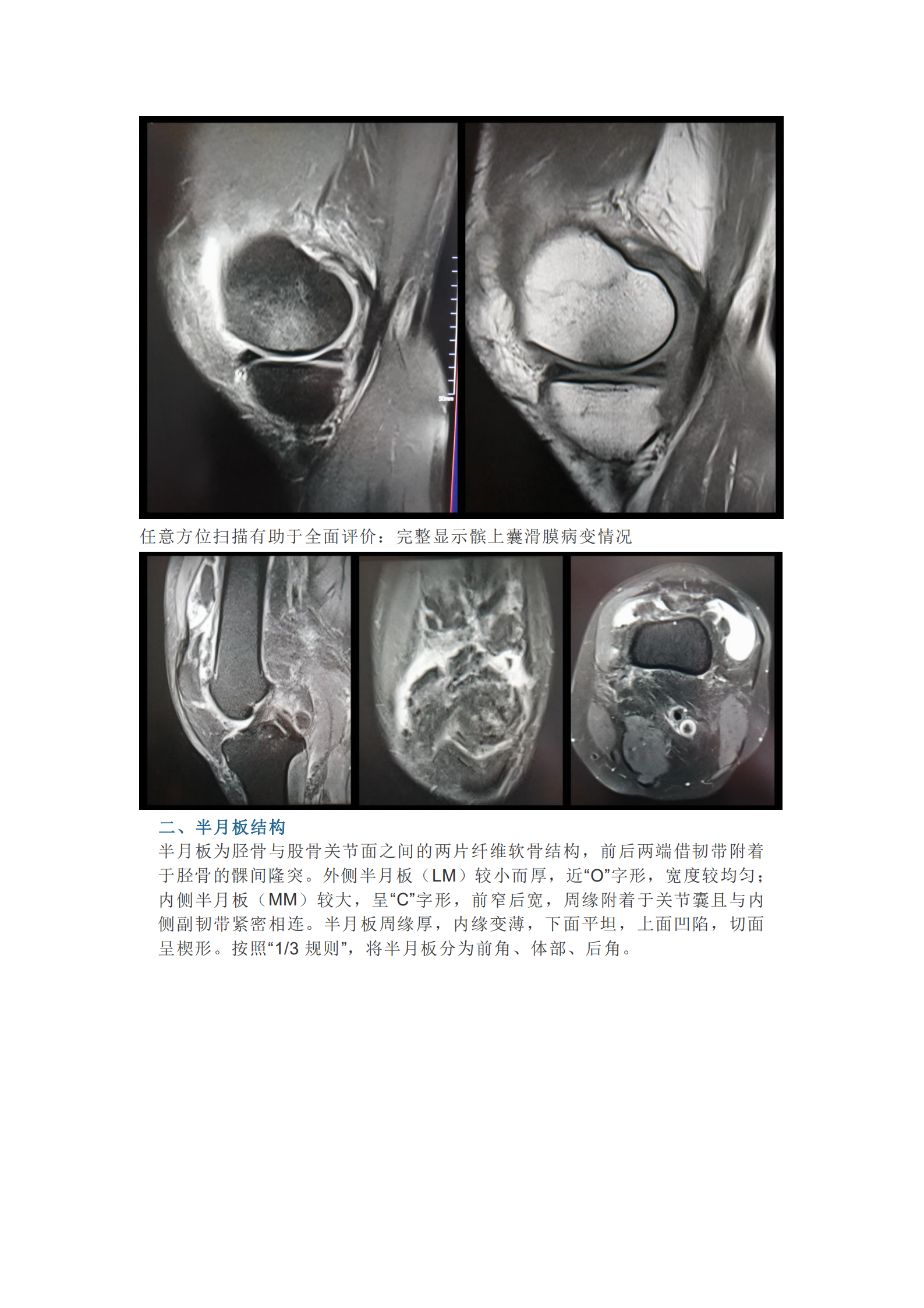 膝关节半月板病变的核磁共振检查的诊断与鉴别