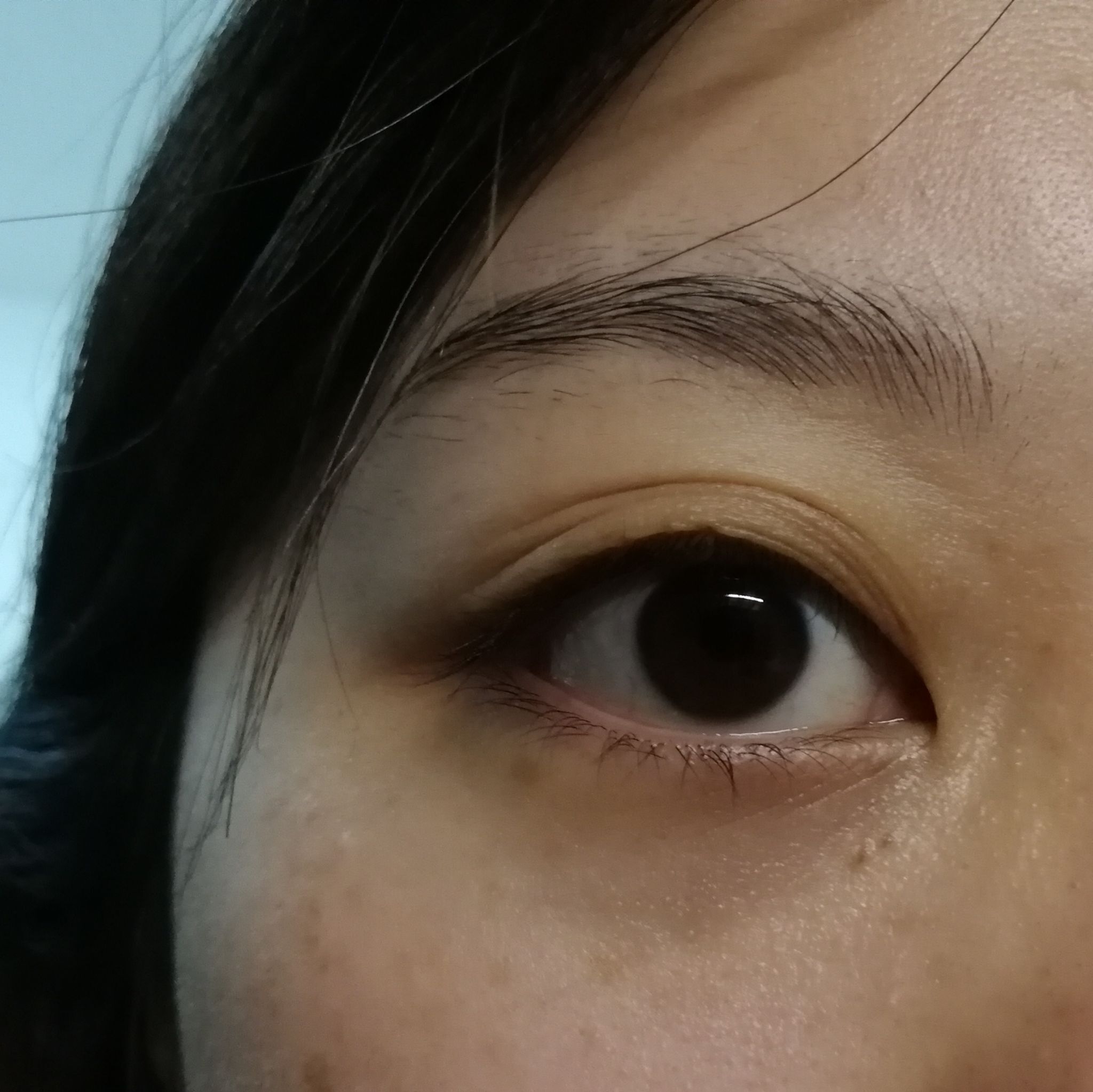 2,眼皮松弛下垂