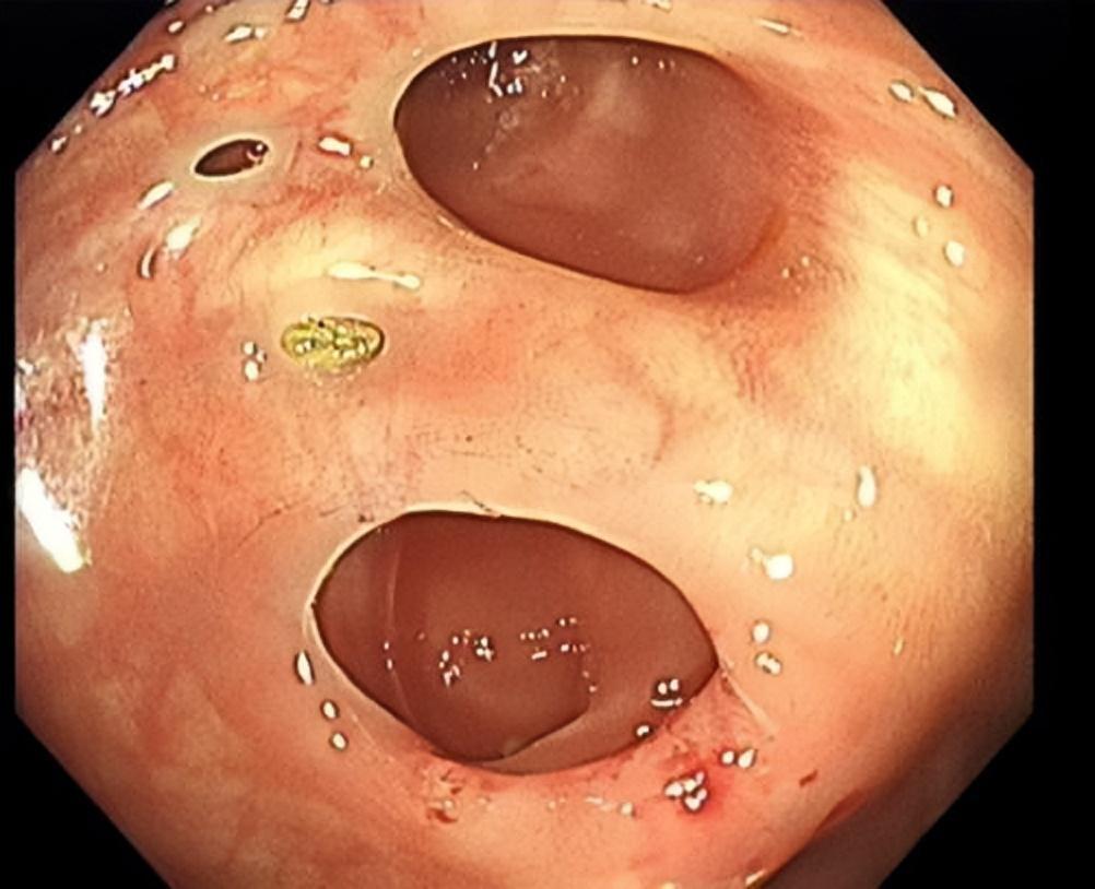 结肠憩室病(colon diverticular disease)