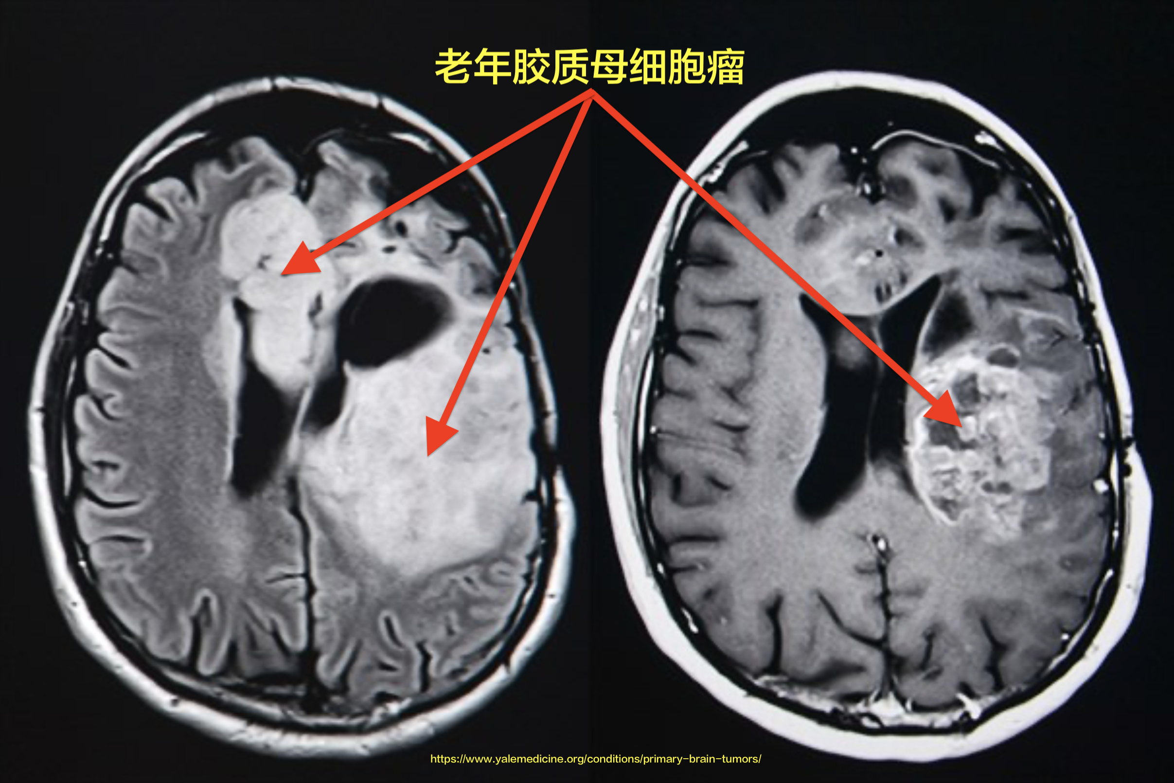 老年胶质母细胞瘤的治疗