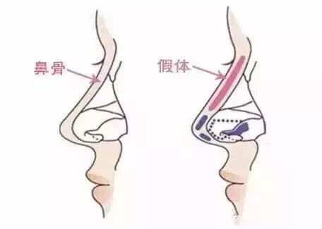 隆鼻后为什么会增生是什么原因导致的