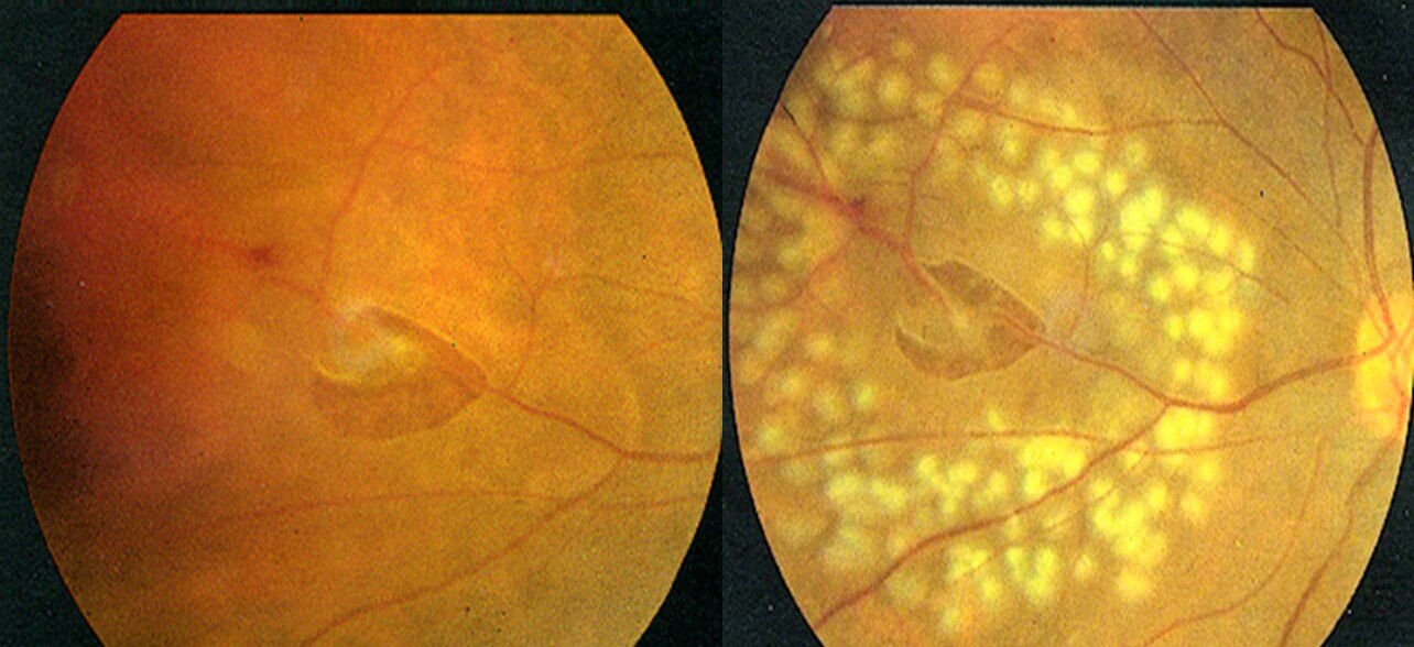 图2视网膜裂孔和激光治疗后的视网膜裂孔.