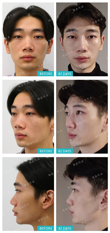 假体隆鼻后,为什么山根晃得厉害?