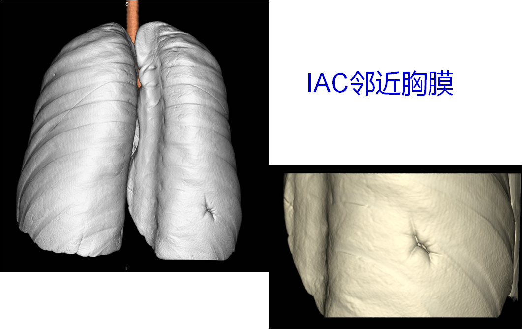 这个结节经过了个性化扫描,胸膜凹陷呈三角形,顶端突入结节内且显示不