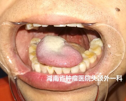 舌癌手术治疗会毁容吗附术前术后的患者相片