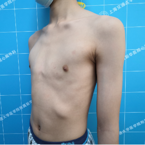 不对称鸡胸微创手术治疗