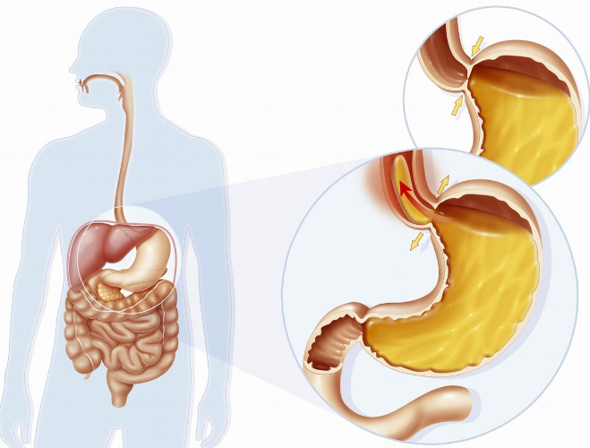为什么老年人更容易得胃食管反流病?医生全面解析