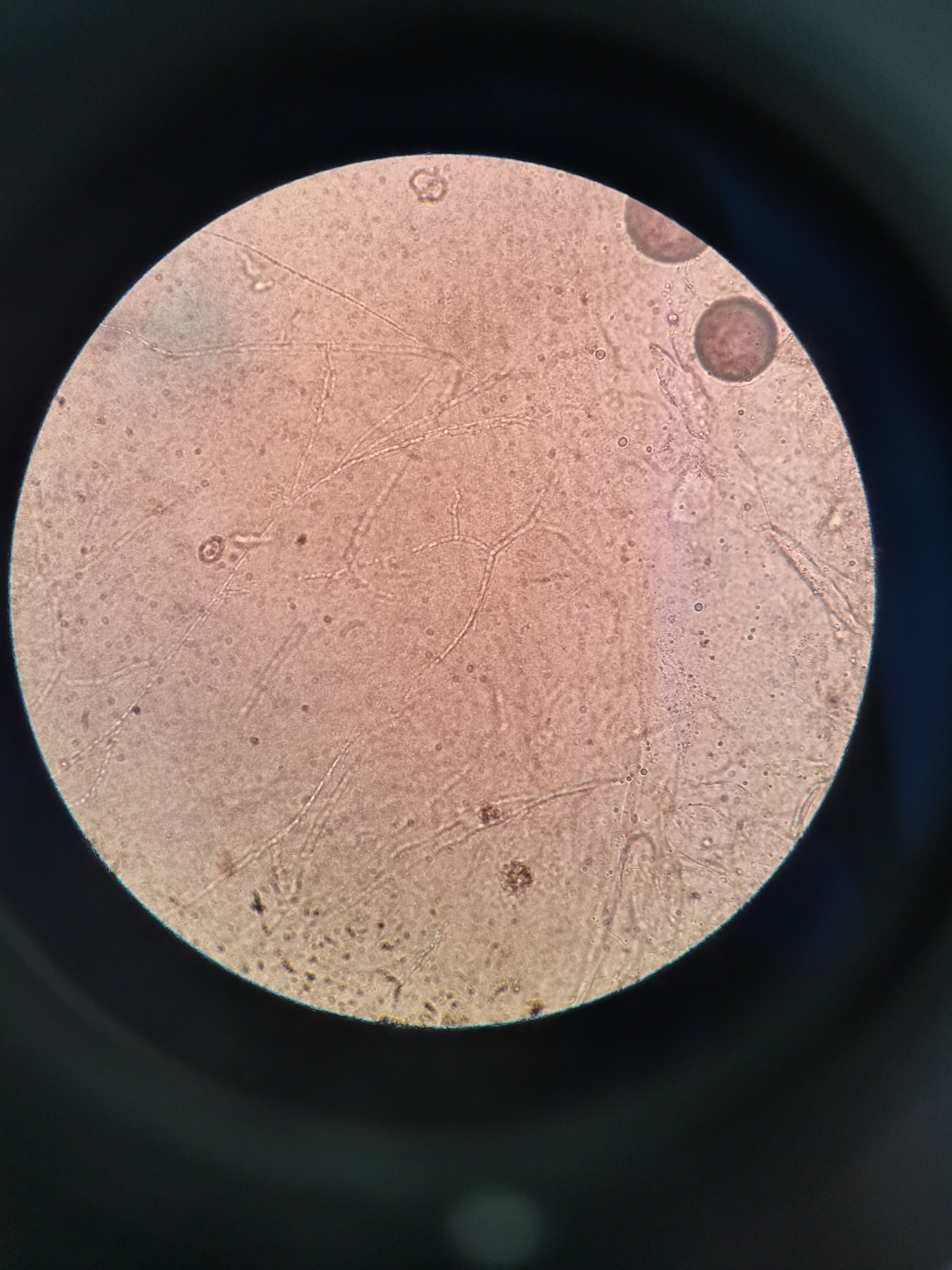 刮取甲屑,在显微镜下检查可见大量菌丝.