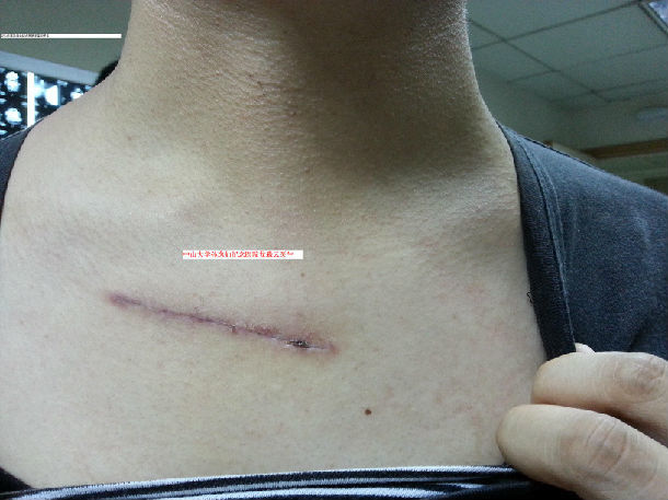 美观的甲状腺手术锁骨下切口