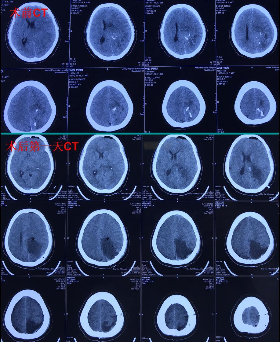 胶质瘤—颅内最常见原发肿瘤,该如何科学对待?