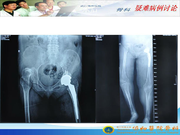 成人双侧先天性髋关节脱位怎么办?全髋关节置换术