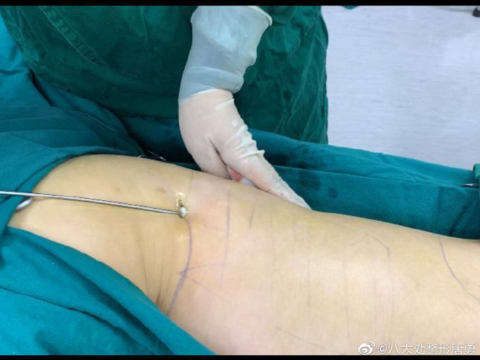 韩式共振吸脂减肥_共振吸脂价格_减肥共振吸脂