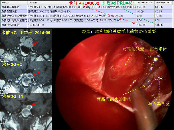 垂体瘤的手术治疗策略-如何根治,避免残留和复发.