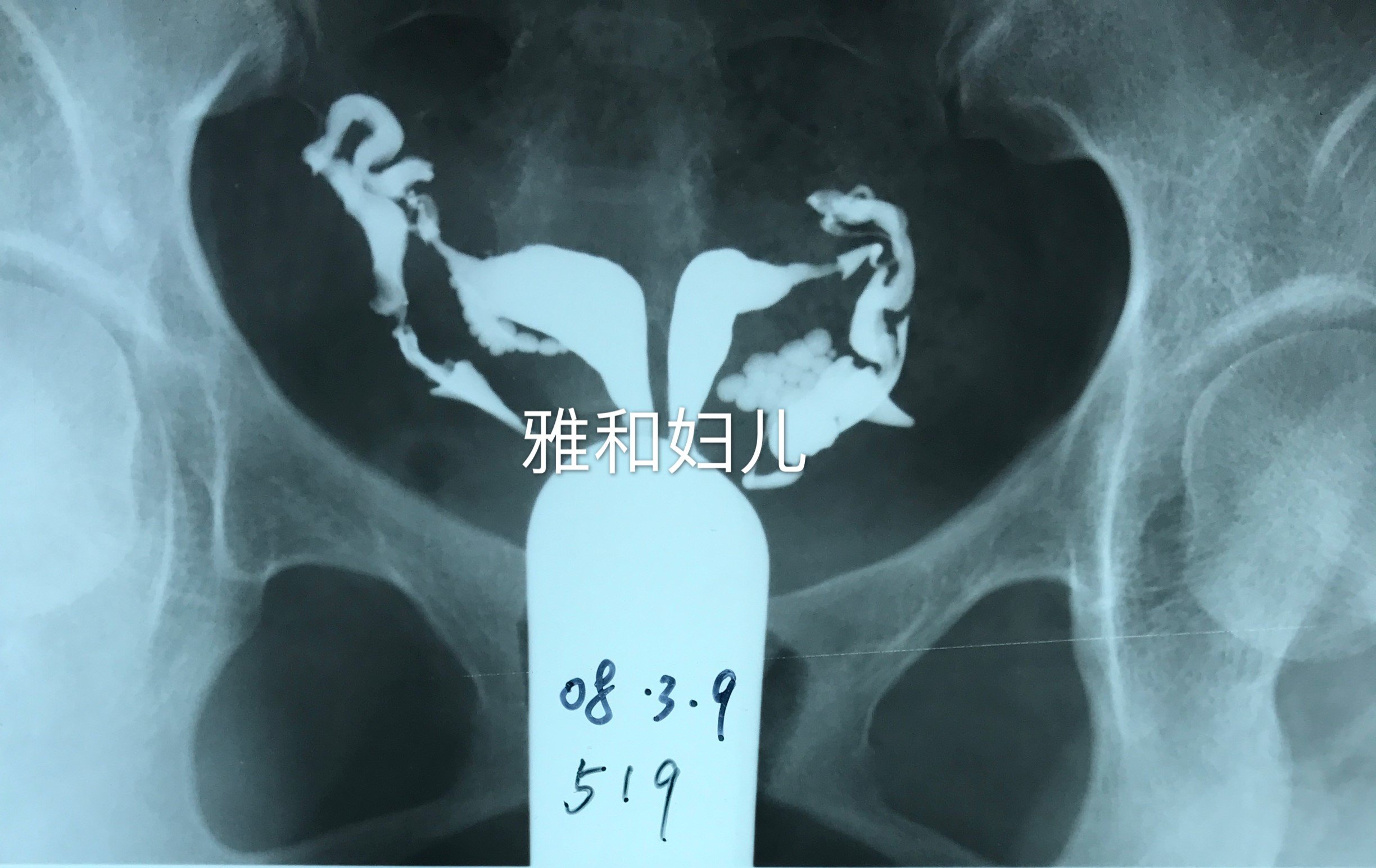 解决大问题的小手术实时动态子宫输卵管碘油造影术