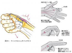②腱鞘炎:手指重复,过度敲击鼠