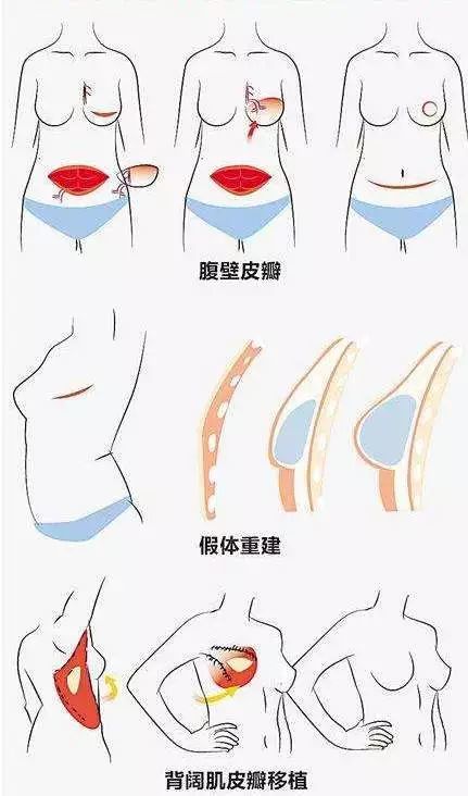 中国 乳腺癌 患者的五年生存率为82%,保乳治疗与常规治疗的术后生存率