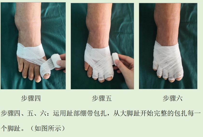 选择无菌绑带对脚趾进行包扎.顺序从大拇指开始依次包扎到小趾.