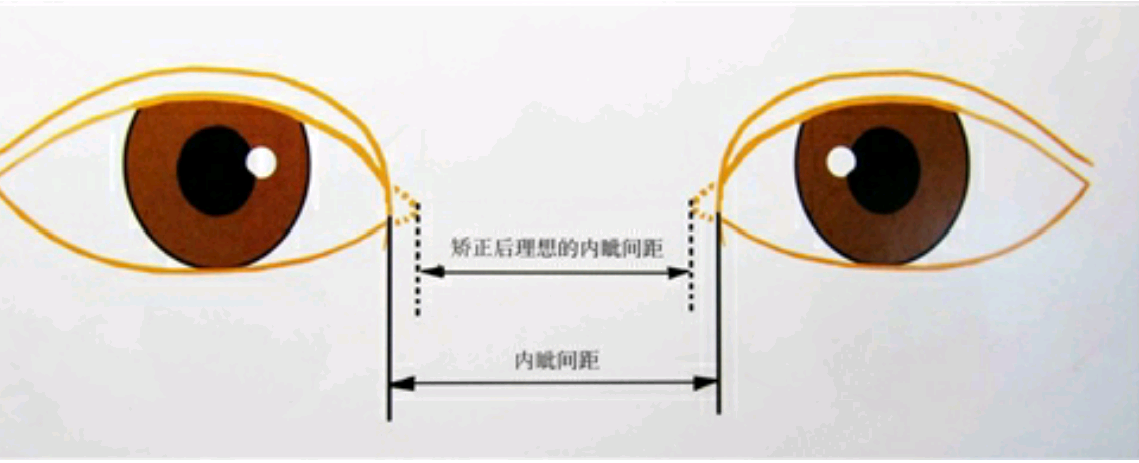 下载客户端 北大医院 周常青 文章列表  内眦赘皮是东方人常见的眼睛