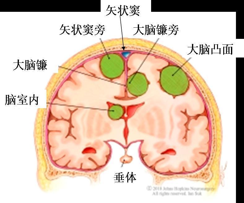 脑膜瘤大多与脑膜相关,根据其发生的解剖部位分为:凸面脑膜瘤,颅底