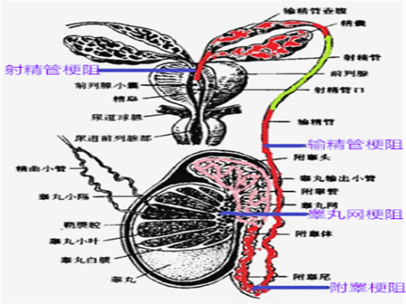 儿时做过疝气手术,射精管发育异常,前列腺中线囊肿压迫,双侧输精管