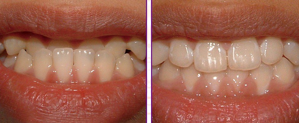 地包天 ",这种牙齿畸形也是非常影响脸型发育的,所以大部分" 地包天 "