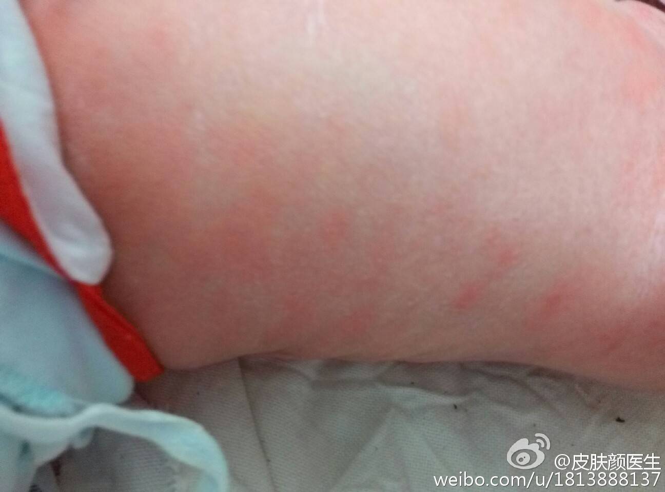 新生儿中毒性红斑是什么鬼?