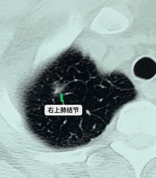 体检发现多个肺部结节怎么判断这些结节的良恶性