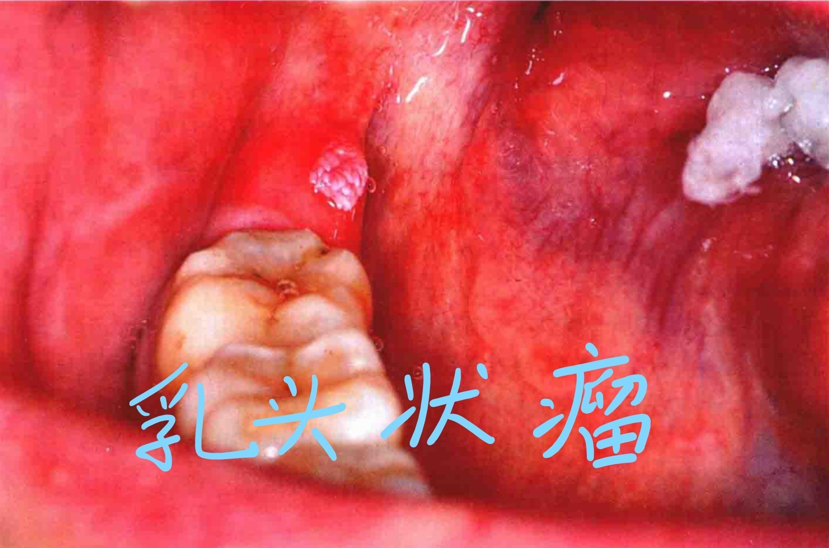 口腔黏膜乳头状瘤的图文介绍