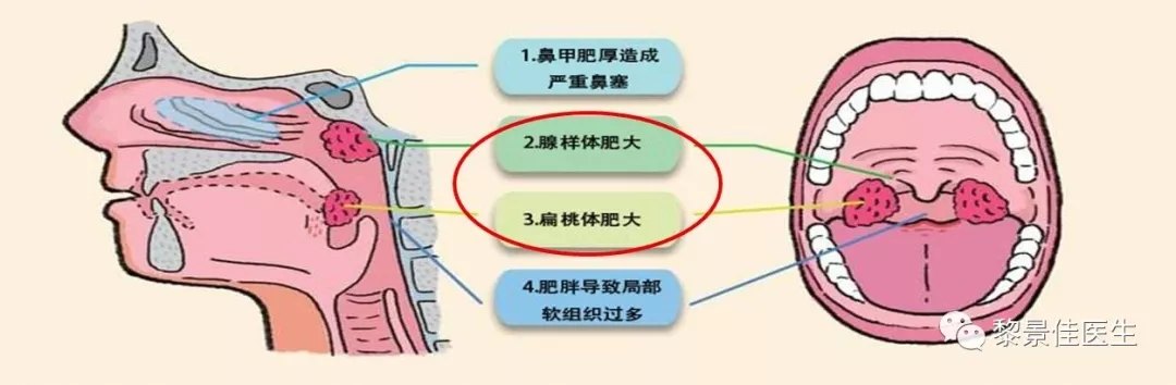 扁桃体,就是张开嘴巴时在喉咙两边看到的"小肉球"