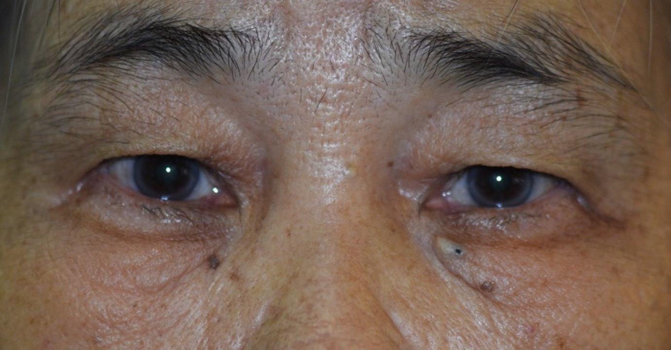 病例二,眼睑皮脂腺囊肿,治疗前