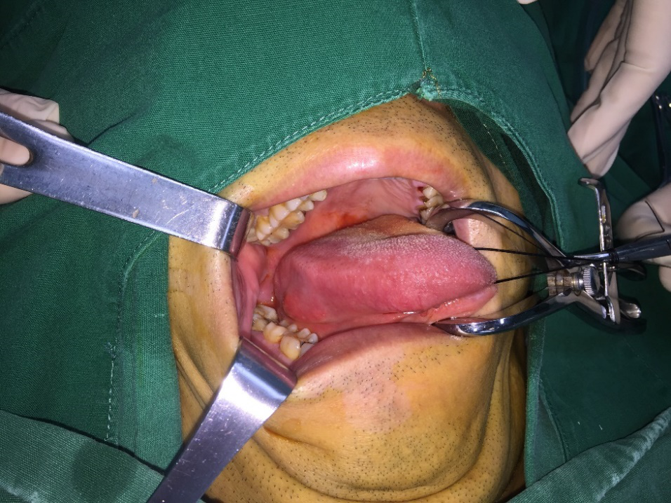 舌头肿瘤?舌头莫名长肿物疑肿瘤 检查才知竟是鱼刺插入舌头?