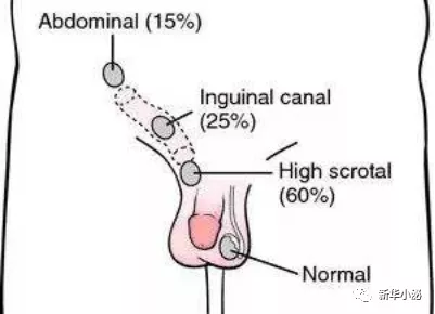 我的蛋蛋去哪了—小儿隐睾_隐睾 好大夫在线
