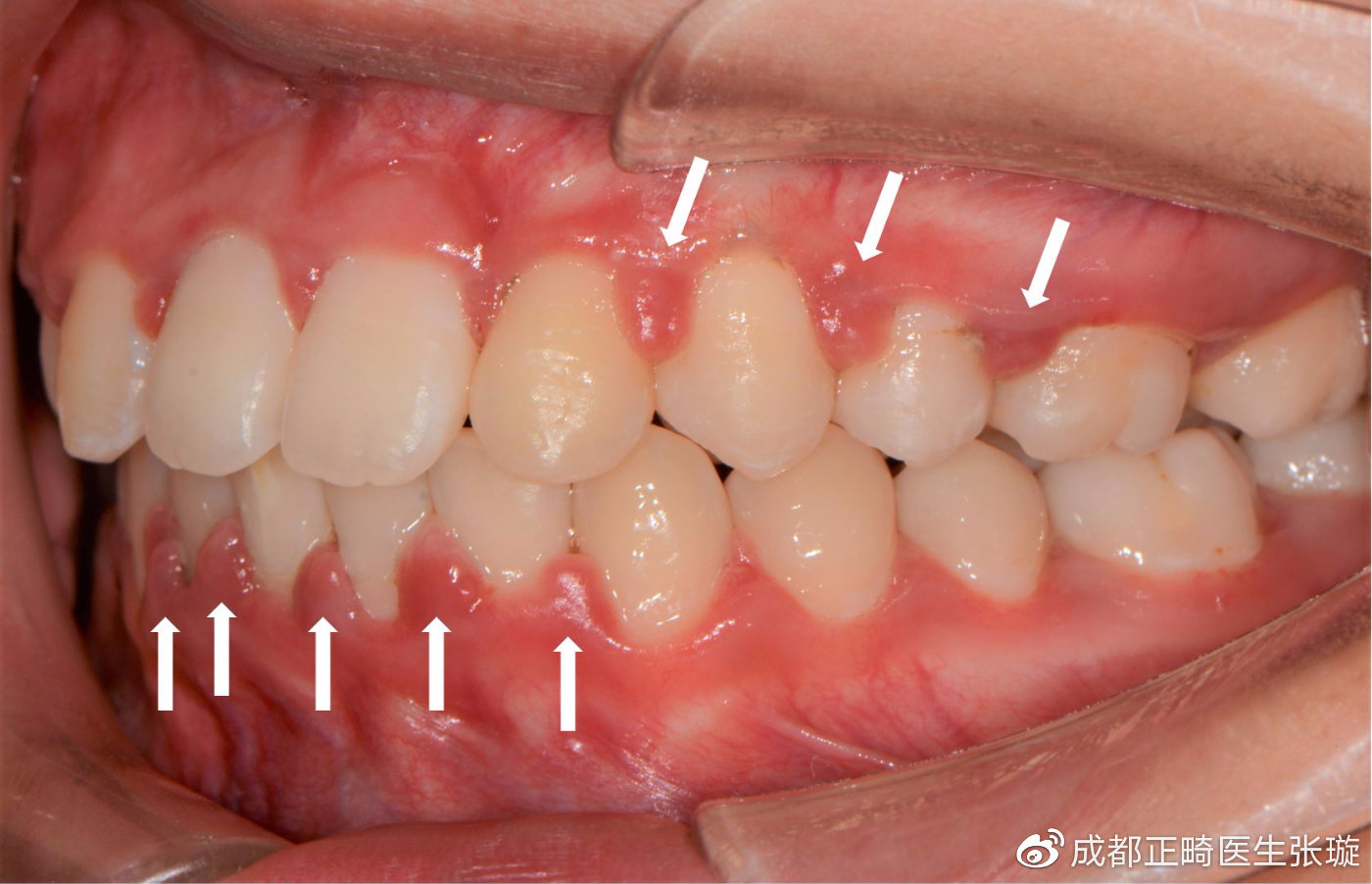 白色箭头所指就是严重增生的牙龈乳头,轻碰即出血