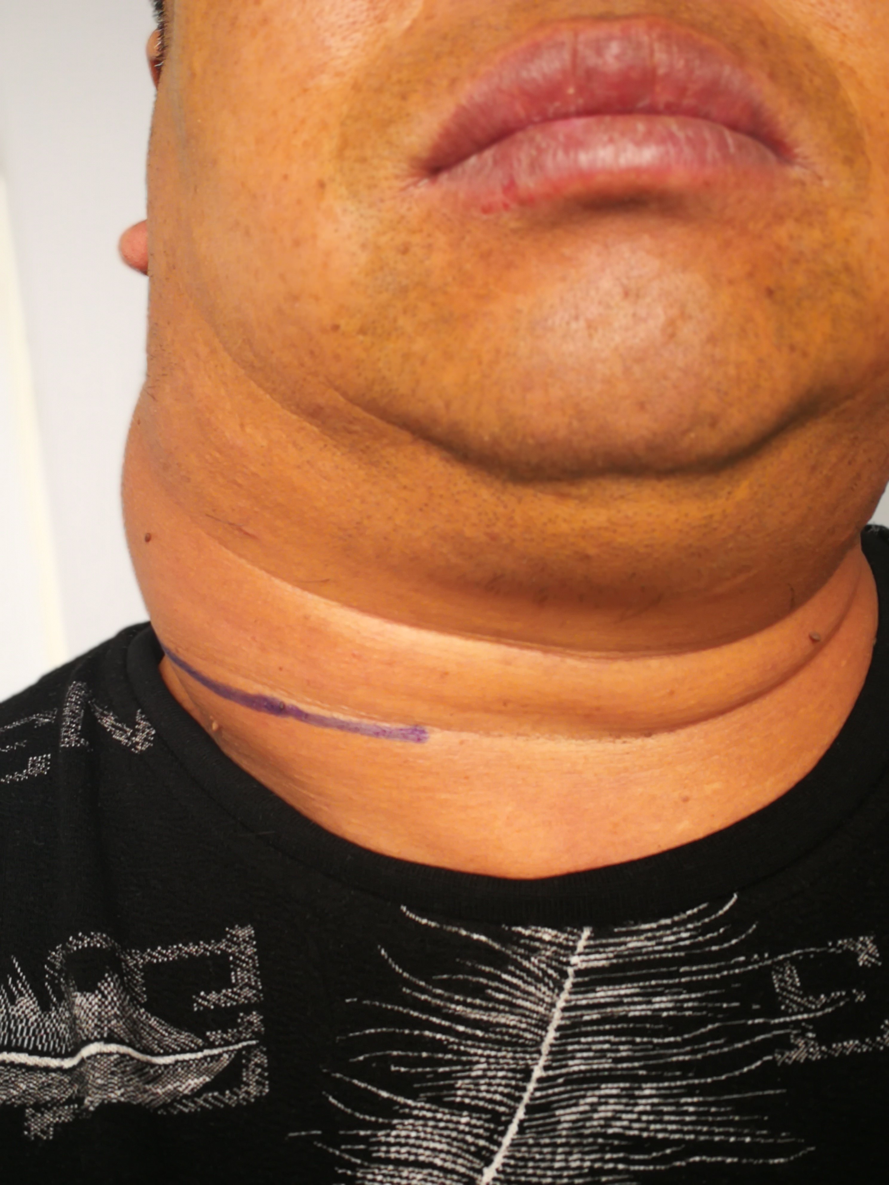 颈部巨大脂肪瘤手术