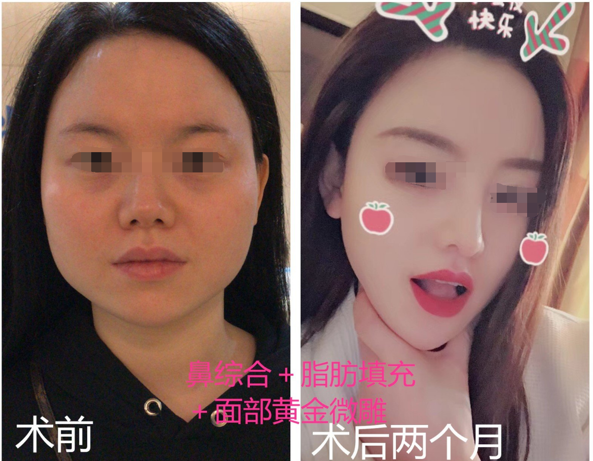 "脸大"如何改善,小手术也可以让大脸变小脸!
