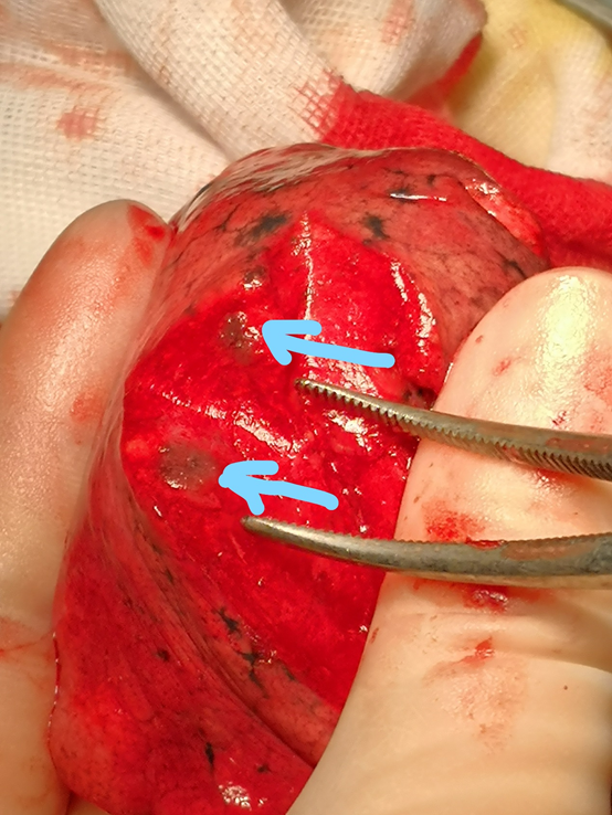 新记录一次微创肺段手术切除4个磨玻璃结节