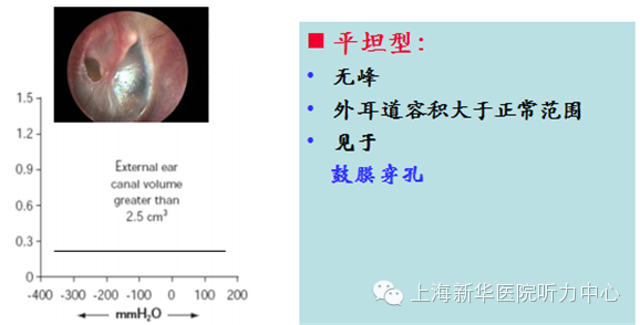 十分钟认识鼓室图