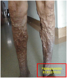 蚯蚓腿小腿皮肤发黑老烂腿原来是下肢静脉曲张惹的祸