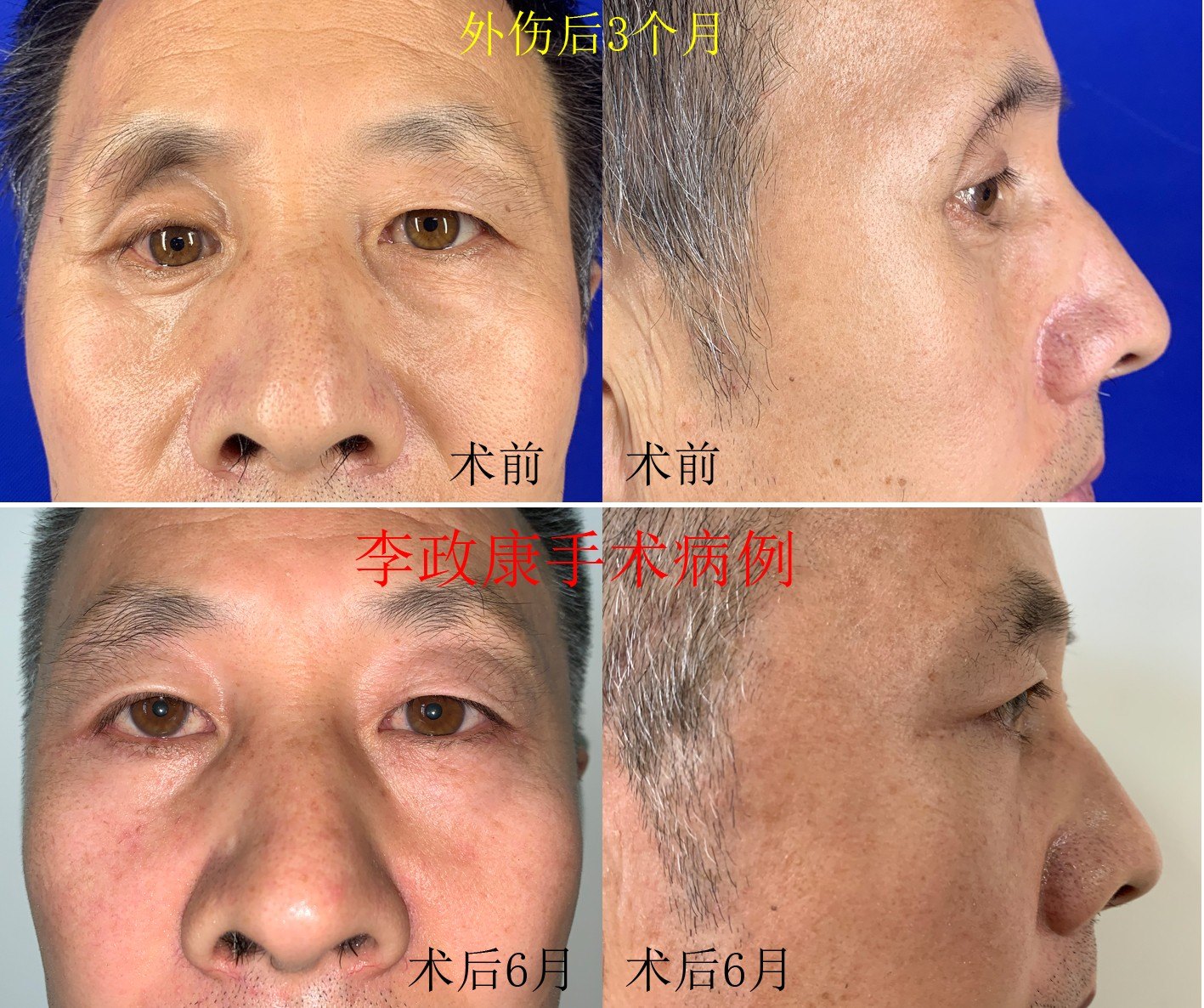 陈旧性单纯和复合型眼眶骨折的手术效果