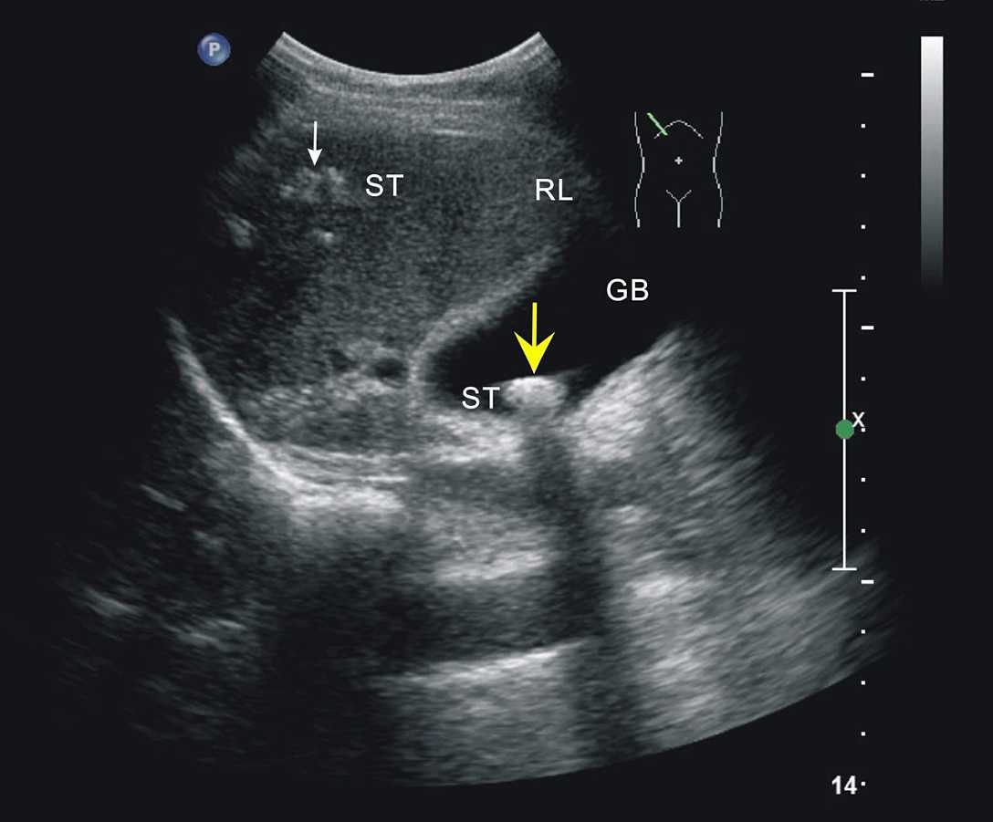 胆结石，插图显示底部视图的肝脏和胆囊结石高清摄影大图-千库网
