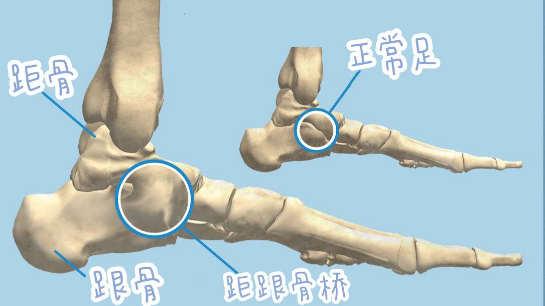 出现在脚上的彩虹跗骨联合是什么