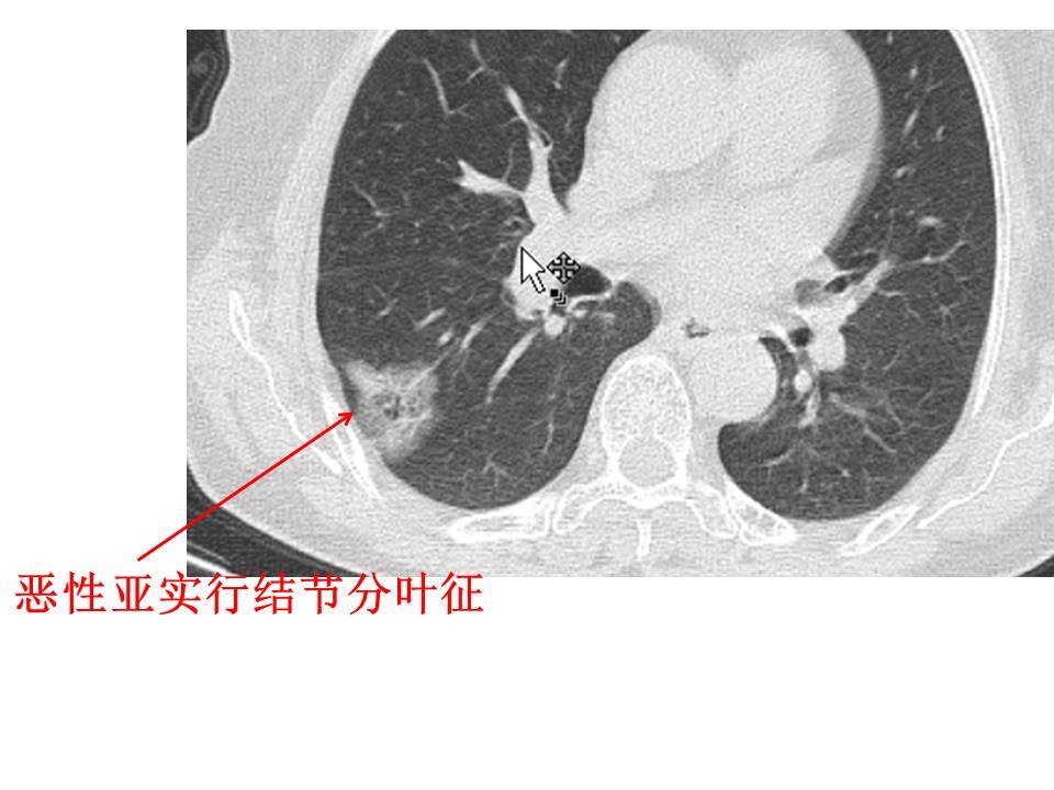 肺结节常见恶性征象之分叶征